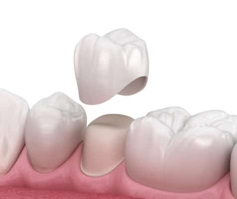 Dental Crowns in Scottsdale, AZ | Crowns & Bridges | Free Consultation