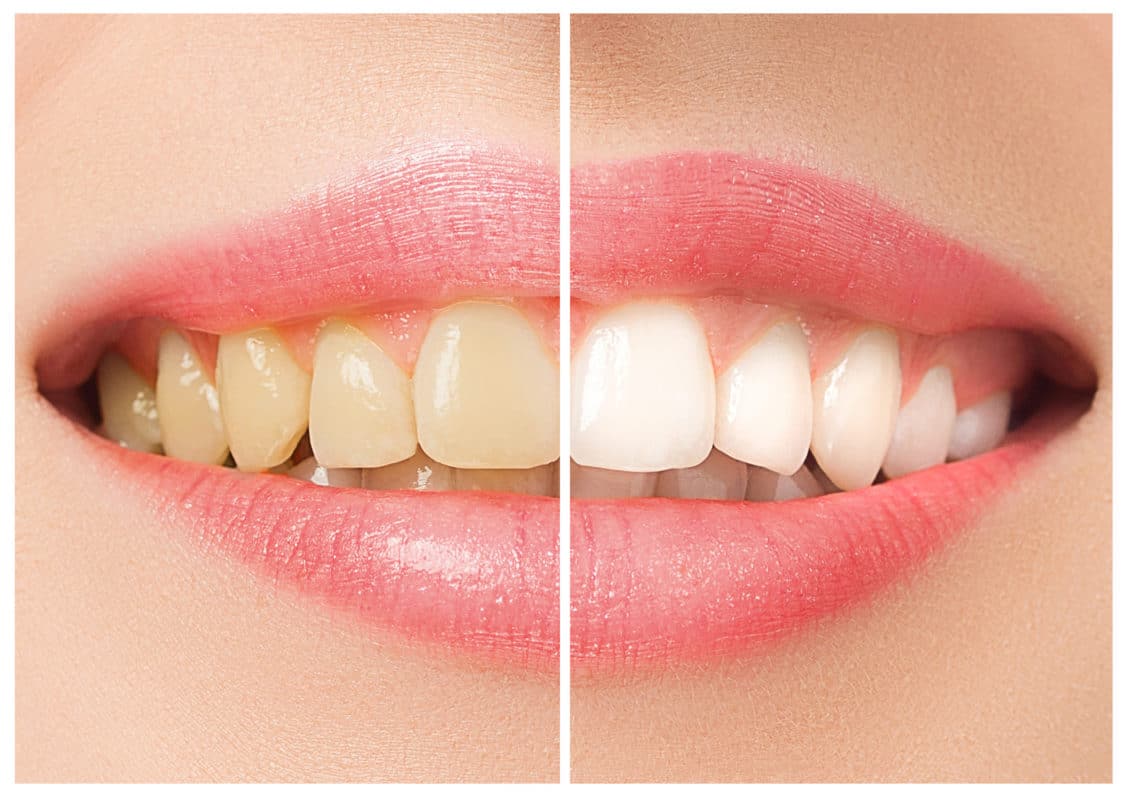 Teeth Whitening in Scottsdale, Arizona Affordable Teeth Bleaching Dentist