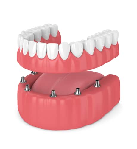 Understanding Snap in Dentures Scottsdale Dentist Free Consultations