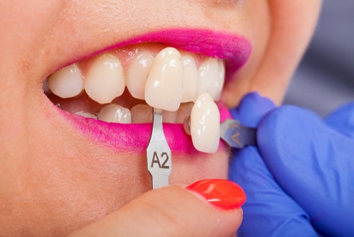 Carillas Conseguir una mejor sonrisa Scottsdale Dentista Cosmético