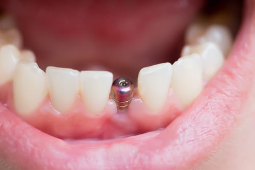 Que Son Los Implantes Dentales AZ Dentista Consultas Gratuitas