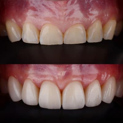 Beneficios de la adhesión dental Scottsdale Cosmetic Dentists