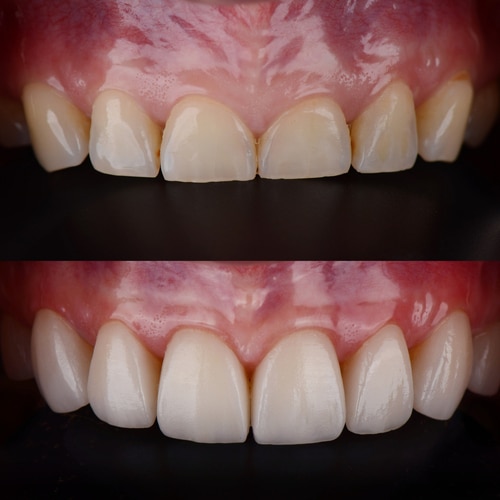 Beneficios de la adhesión dental Scottsdale Cosmetic Dentists