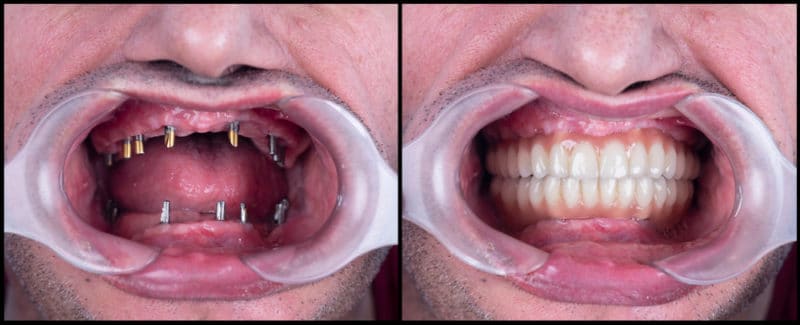 ¿Qué son Snap en Dentaduras Scottsdale Dentista Cosmético