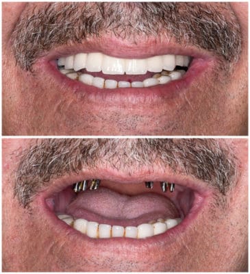 Mesa Implant Dentist Consultas Gratis AZ Dentista