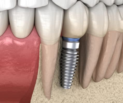 Scottsdale Implant Dentist Consultas gratuitas