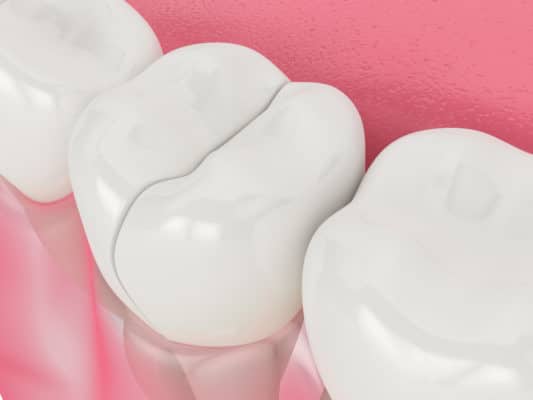 Broken Teeth Causes & Solutions Scottsdale, AZ Dentists