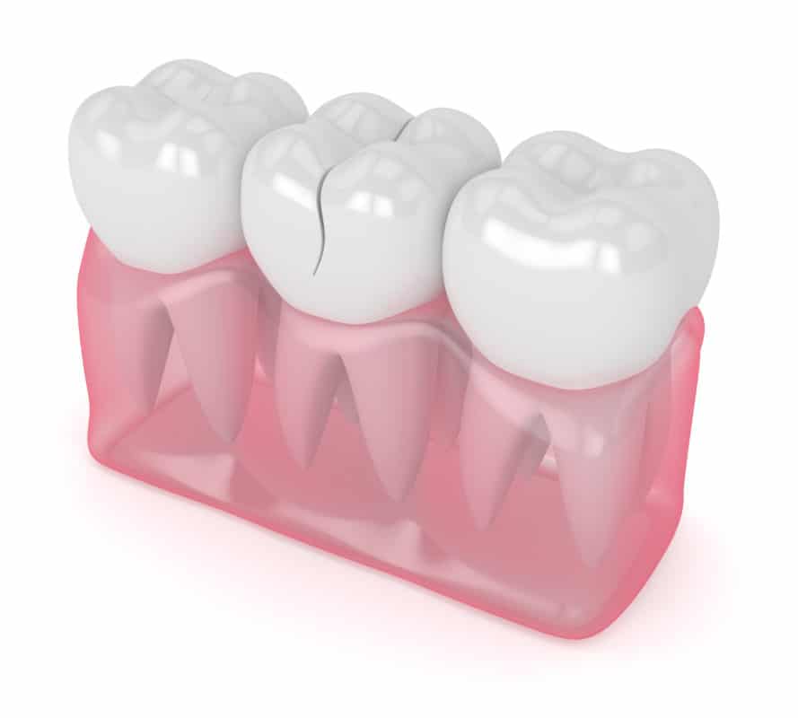 Soluciones para un diente astillado Scottsdale Cosmetic Dentist