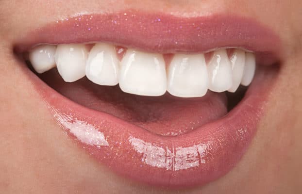What Are Composite Resin Veneers Scottsdale AZ Dentist
