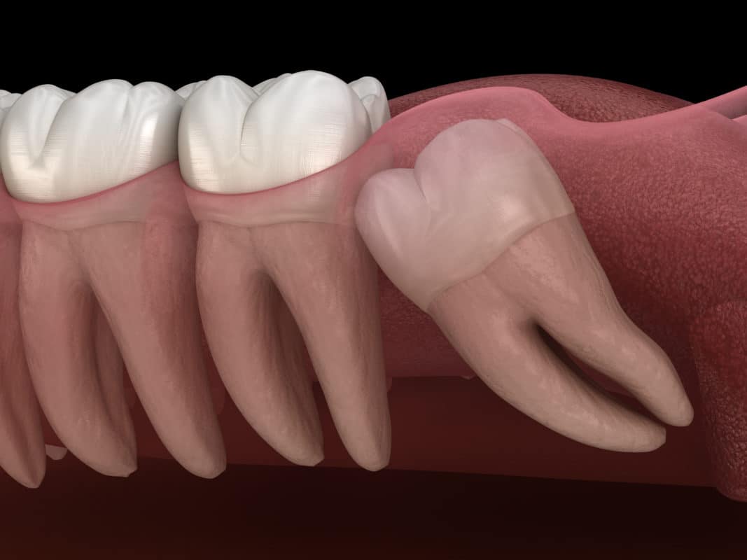 Wisdom Teeth Removal FAQs Scottsdale Dentist Extractions