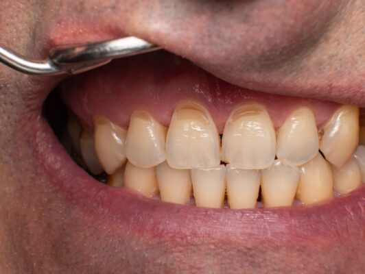 Elimina las manchas en los dientes con estos 3 tratamientos en Scottsdale, Arizona