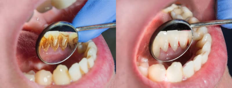 Arregla los dientes manchados con estos tratamientos Dentista Estético