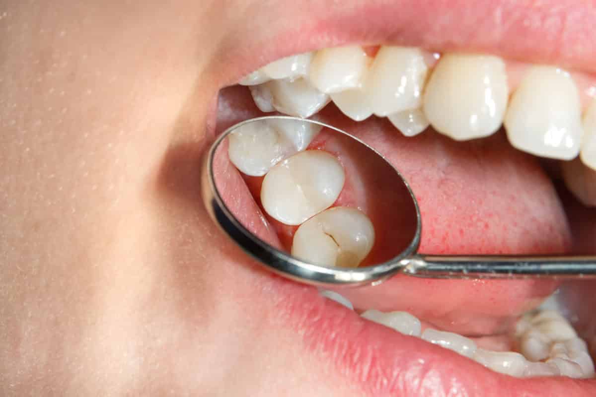 Cómo prevenir la caries dental Scottsdale Dentista Prevención