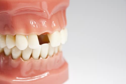 4 Mini Implante Dental Procedimiento Preguntas Frecuentes | Scottsdale AZ Dentista