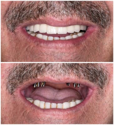 5 pasos de reconstrucción bucal completa Scottsdale AZ dentistas