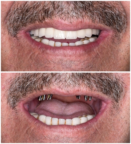 5 pasos de reconstrucción bucal completa Scottsdale AZ dentistas