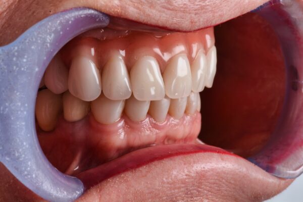 Dentaduras inmediatas en Scottsdale Mini Dental Implant Centers of America