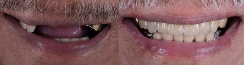Dentaduras Mini Implantes Preguntas Frecuentes Dentista Scottsdale Exámenes Gratuitos