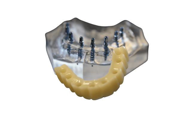 Estabilización de prótesis con mini implantes dentales Scottsdale