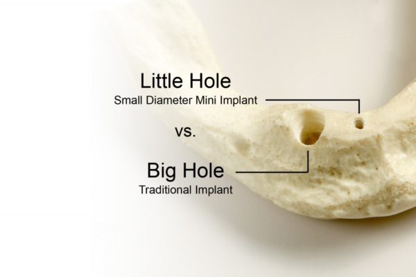 Mini Implants Say Goodbye to Missing Teeth & Unstable Dentures Today