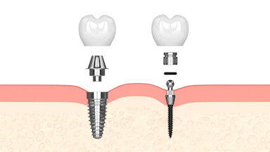 Dental Implants in Scottsdale, AZ | Mini Implant Dentist | Dr. Mann