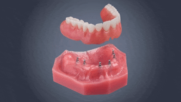 Alternativas de Dentadura en Scottsdale, AZ | Mini Implantes Dentales